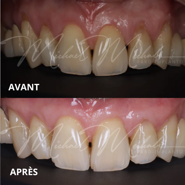 Cas avant / après de greffe de gencive soins d'implantologie et de parodontie