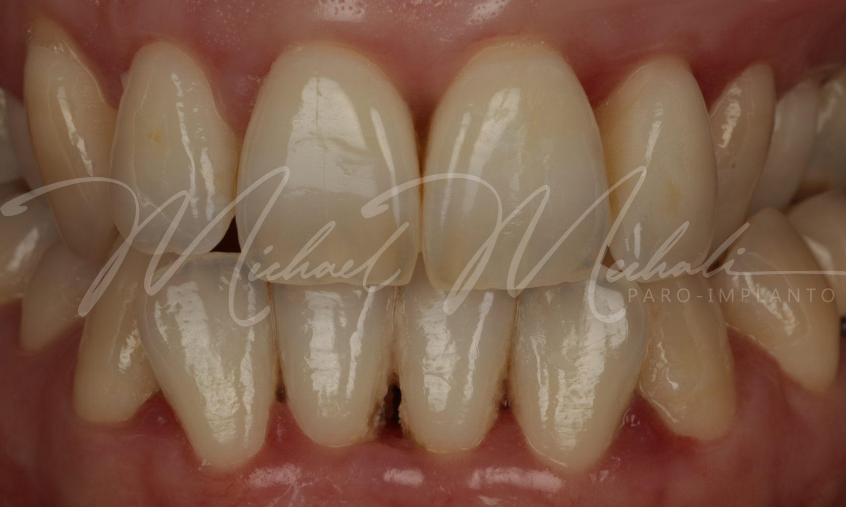 Exemple de gingivite traitée par le chirurgien dentiste Michael Mechali. Parodontie.